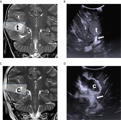 Intraoperative Ultrasound-Assisted Extent of Resection Assessment in Pediatric Neurosurgical Oncology